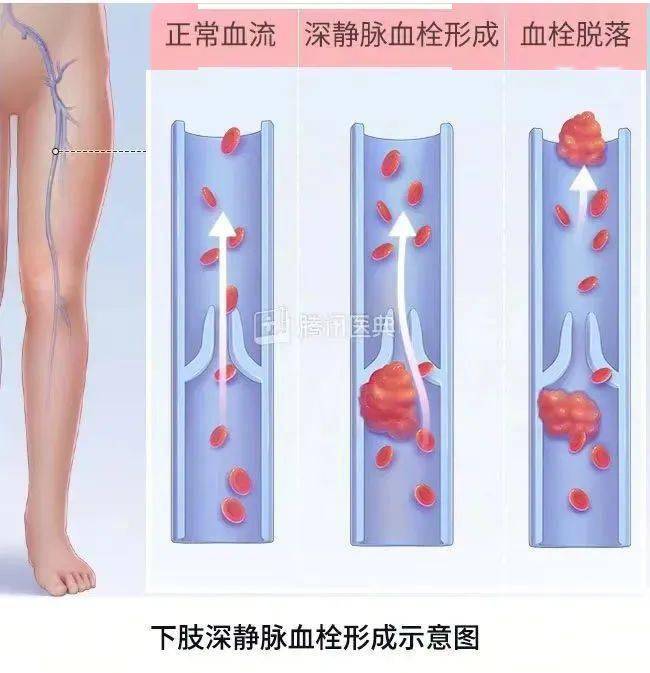 护理小常识：长期卧床者谨防下肢静脉血栓形成