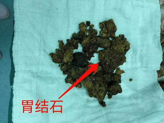 胃一不小心也会结石！日常饮食注意10点不要忽略这8个症状